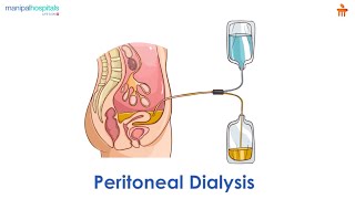 What is Peritoneal dialysis l Manipal Hospitals Bengaluru [upl. by Enid]