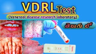 VDRL Test Venereal disease research laboratoryMLTTeluguLabVDRL Test తెలుగు లో [upl. by Ahselrak]