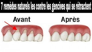 Les 7 remèdes naturels les plus efficaces contre les gencives qui se rétractent [upl. by Moll]