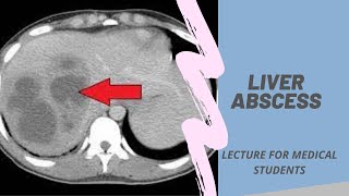 Liver abscess  Lecture for Medical Students mbbs neet usmle fmge neetpg [upl. by Akim257]