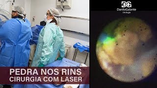 Pedras nos rins  Cirurgia a laser [upl. by Gearhart138]