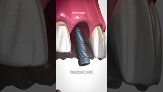 Dental implantsBone Graft dental shorts dentaltreatment twitch youtubeshorts implantfyp [upl. by Siocnarf399]