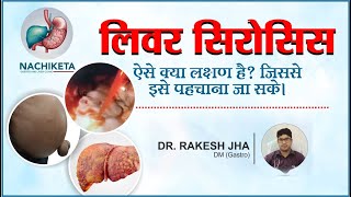 लिवर सिरोसिस के लक्षण क्या हैं जिससे इसे पहचाना जा सके  Best Gastroenterologist Doctor in Patna [upl. by Hinda650]