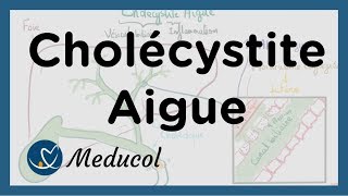 Cholécystite aiguë inflammation vésicule biliaire symptômes colique biliaire et cholécystectomie [upl. by Domenico]