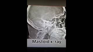 mastoid x ray ear x ray radiology shortvideo [upl. by Fitalludba]