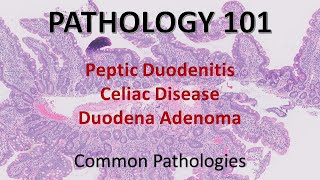 Peptic Duodenitis Celiac Disease Duodenal Adenoma  Pathology 101 GI Pathology [upl. by Aelahs]