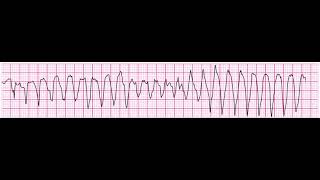 Torsades de Pointes 200bpm polymorphic ventricular tachycardia [upl. by Giacopo41]