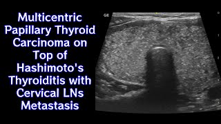 Multicentric Papillary Thyroid Carcinoma on Top of Hashimotos Thyroiditis with Cervical LNs Mets [upl. by Rogerio]