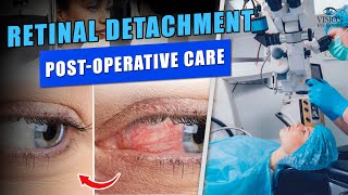 Retinal Detachment PostOperative Care What to Expect [upl. by Iand]