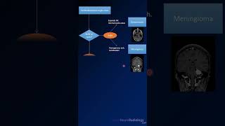 Imaging differential for Cerebellopontine Angle CPA masses radiology MRI tumors [upl. by Qahsi]