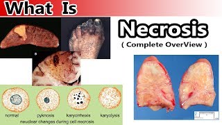 What is Necrosis  Complete Overview [upl. by Federica]