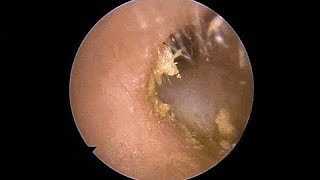 Milia Removal The first person to clean earwax after 35 years of life 02 [upl. by Corry]