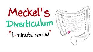 Meckels Diverticulum 1minute review [upl. by Star]