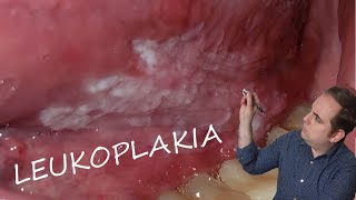 Leukoplakia Common Oral Pathology [upl. by Jonah]