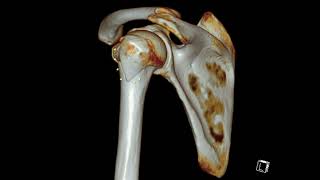 Humerus Greater Tuberosity Fracture [upl. by Hutchinson968]