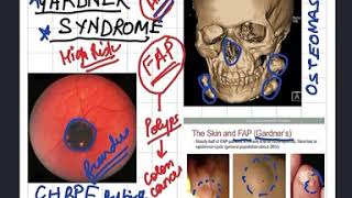 Gardner Syndrome related to Familial Adenomatous Polyposis [upl. by Evan402]