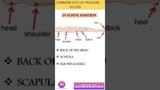 PRESSURE ULCERS amp COMMON SITES FOR PRESSURE ULCERS [upl. by Aivatra]