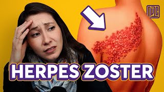 Como se pega Herpes Zoster [upl. by Vargas]