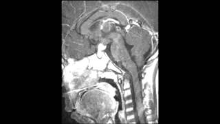 Langerhans Cell Histiocytosis of the Pituitary Gland [upl. by Gleich]