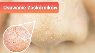 5 naturalnych sposobów na usunięcie zaskórników [upl. by Lampert]