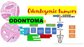 Odontoma DETAILED  Histopath DIAGRAMSComplex vs Compound odontoma  Tumors of odontogenic origiN [upl. by Ardek]