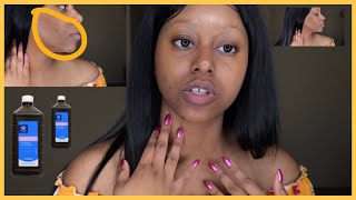 Using Hydrogen Peroxide for Hyperpigmentation amp bumpy skin  🇨🇩🇿🇦🇺🇸 [upl. by Towbin]