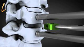 Hernie discale cervicale  Spinal disk herniation  Kisco International [upl. by Ebocaj]