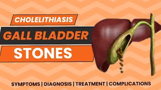 Cholelithiasis  GallStones  Gallbladder Stones  Symptoms  Diagnosis  Treatment  Complications [upl. by Krystalle688]