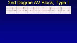 ECG interpretationModule4c AV Junctional Blocksmp4 [upl. by Eki336]