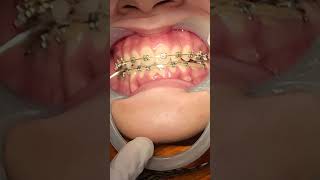 Align teeth after braces [upl. by Behlau]