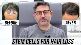 STEM CELL Hair Restoration 4 month Update [upl. by Netsirk]