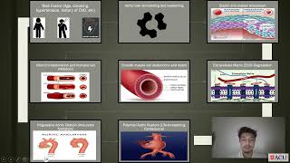 NRSG265 A1 Aortic Aneurysm pathophysiology S00388310 [upl. by Dupuis]