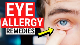 Eye Allergy Remedies  Tips for Itchy and Watery Eyes [upl. by Inverson]