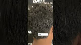 Alopecia Areata Treatment with ILS at Skinaa Clinic viral shorts [upl. by Hestia]