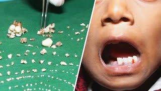 Doctors Remove Over 500 Teeth From Boys Mouth [upl. by Alanah]