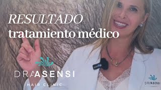 Resultado tratamiento con dutasteride en ASENSI CLINIC [upl. by Petronia]