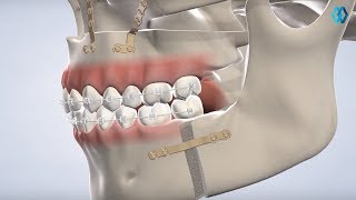 Orthognathic Surgery at North Jersey Oral amp Maxillofacial Surgery Teaneck NJ [upl. by Amarillis305]