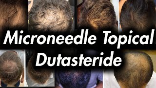 Topical Dutasteride  Microneedling STOPS Hair Loss [upl. by Iadrahc]