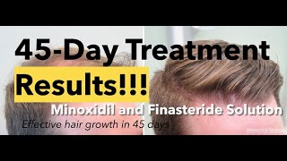 Minoxidil and Finasteride 5 Topical Solution results after 45 days and shedding phase [upl. by Ettenawtna]