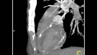 Vascular Diseased LAD 3D and 4D mapping of the coronary CT angiogram2 of 2 [upl. by Nicolas]