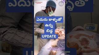 Breech delivery drkranthigynecologist ఎదురు కాళ్ళ తో ఉన్న బిడ్డ [upl. by Liagabba]