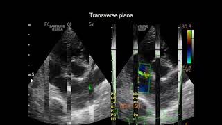 Pulmonic stenosis in a dog [upl. by Jos]