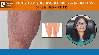 How to Treat Leg Discolouration due to Stasis Dermatitis or EczemaDrAruna PrasadDoctors Circle [upl. by Elladine227]