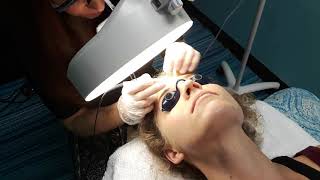 Electrolysis A Permanent Solution For Unruly Eyebrows [upl. by Ehctav]