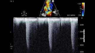 Mitral stenosis measurements [upl. by Henn967]