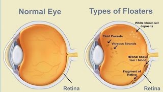 Causes Eye Floaters [upl. by Zedecrem]