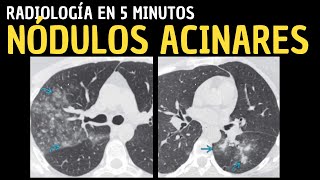 Radiología en 5 minutos Signos radiológicos pulmonares Nódulos acinares [upl. by Nolita]