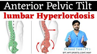 correction exercises for lumbar hyperlordosis anterior pelvic tilt  in hindi  Physiopoint [upl. by Jarl726]