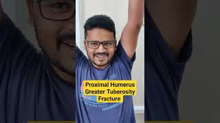 Proximal Humerus Greater Tuberosity Fracture Dr Sai Chandra MBBS DNB Ortho [upl. by Liv]