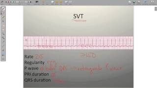 ECG Atrial Rhythms AF AFRVR SVT PAC [upl. by Ycal]